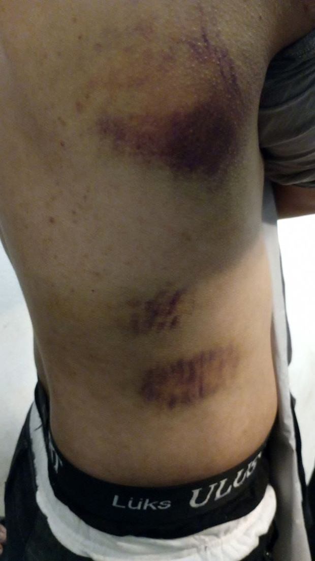 Ozljede koje su palestinske izbjeglice pretrpjele nakon pušbeka koji je nad njima provela hrvatska policija 24. marta 2024. (Foto: Bloody Borders)